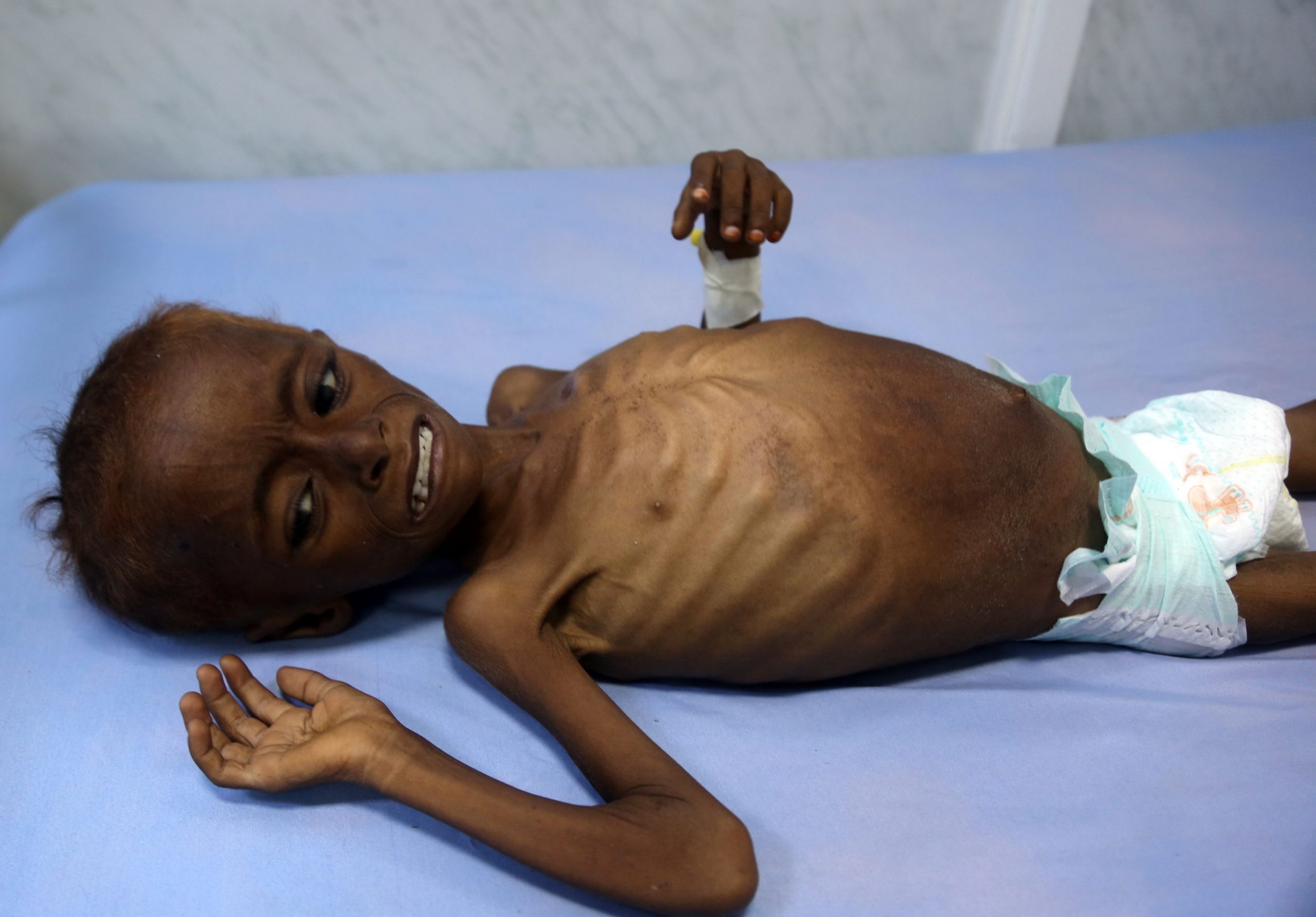 349356 أطفال اليمن يعانون من سوء التغذية1709234223 scaled