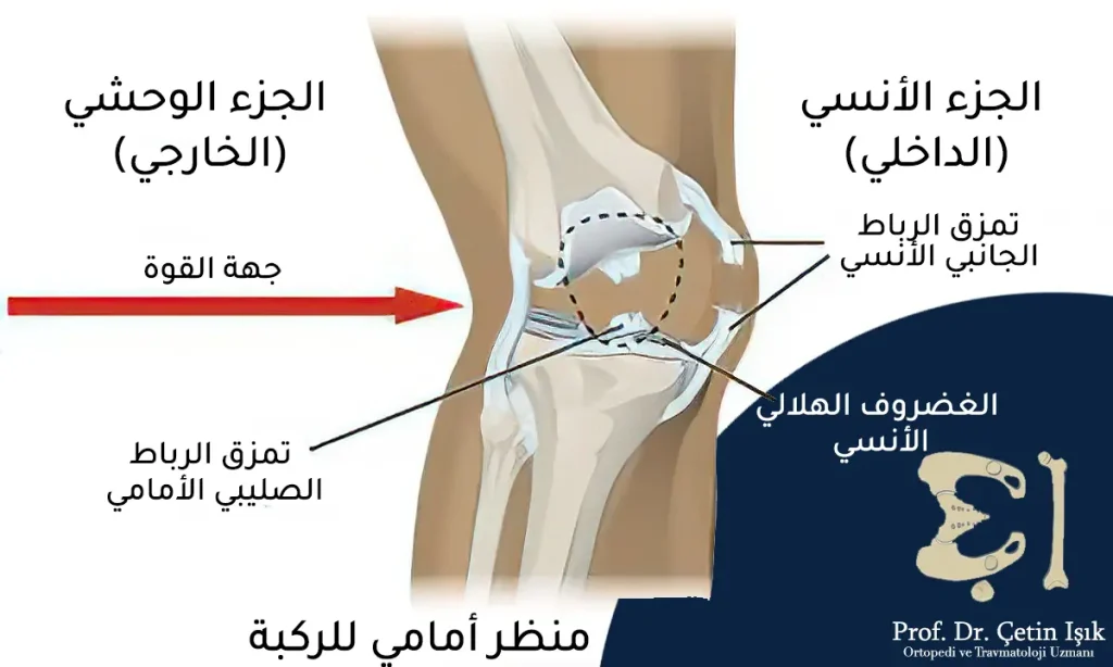 أفضل طرق علاج الرباط الجانبي للركبة 4