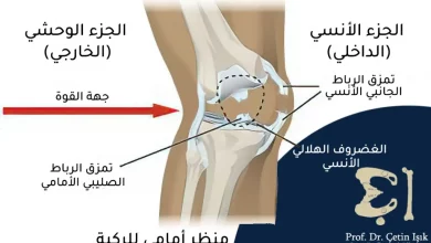 أفضل طرق علاج الرباط الجانبي للركبة 4 1024x6141718132345